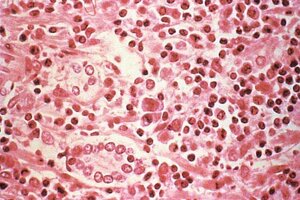 Photomicrograph-liver-tissue-hantavirus-pulmonary-syndrome-patient-4106060072.jpg